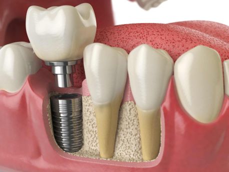 Implant Retained Dentures 