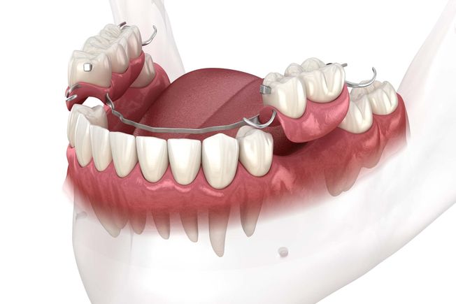 Partial Dentures